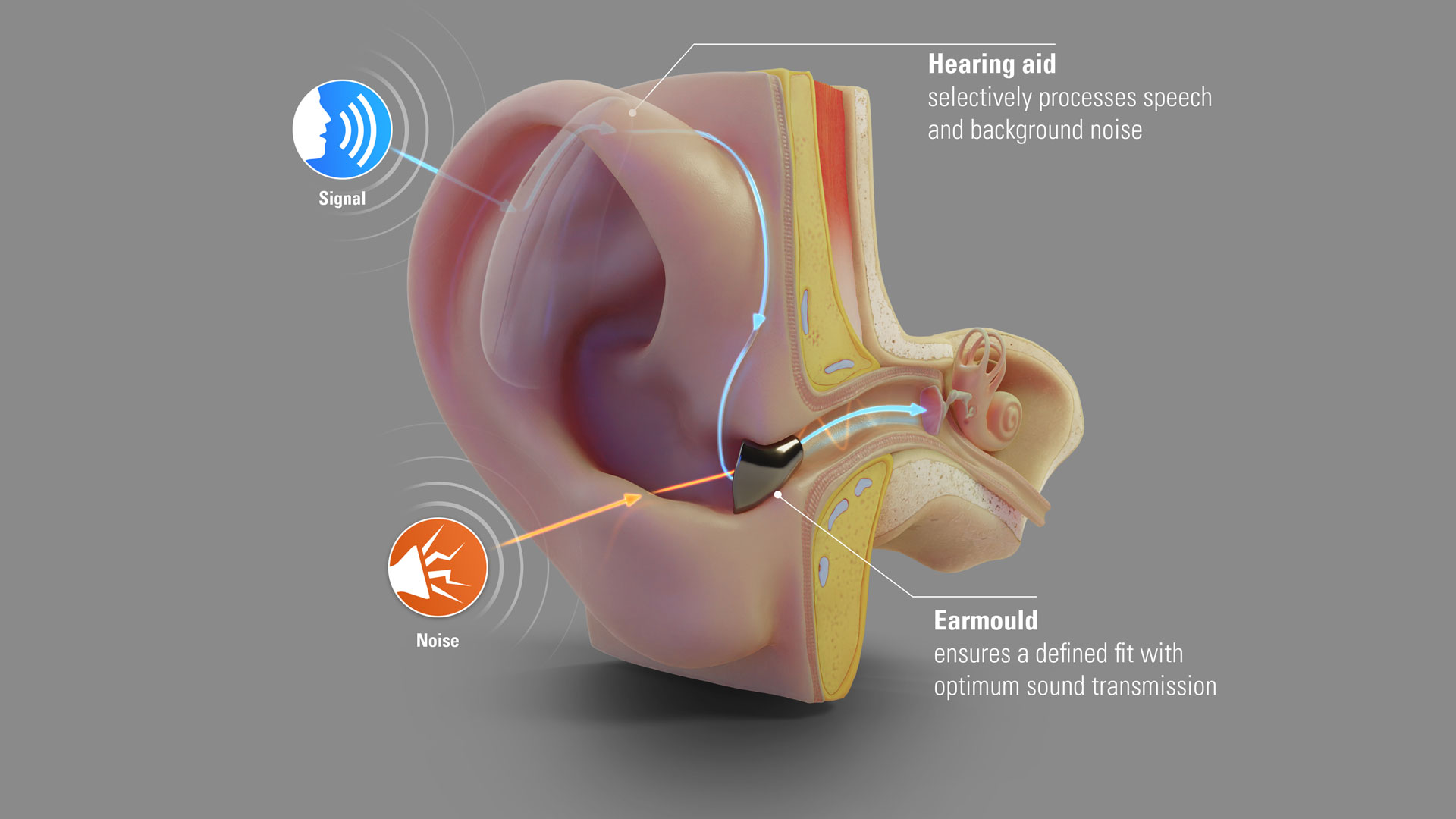 Advantages of an earmould